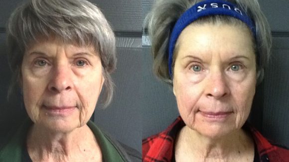 BeforeAfter1Before & After Tempsure™Envi Skin Care Treatment Before & After Tempsure™Envi Skin Care Treatment