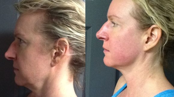 Before & After TempSure Skin Care Before & After TempSure Skin Care